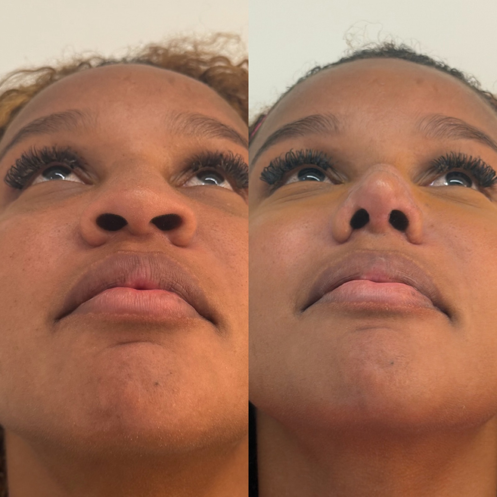 Resultado real de paciente Prime HOF — antes e depois