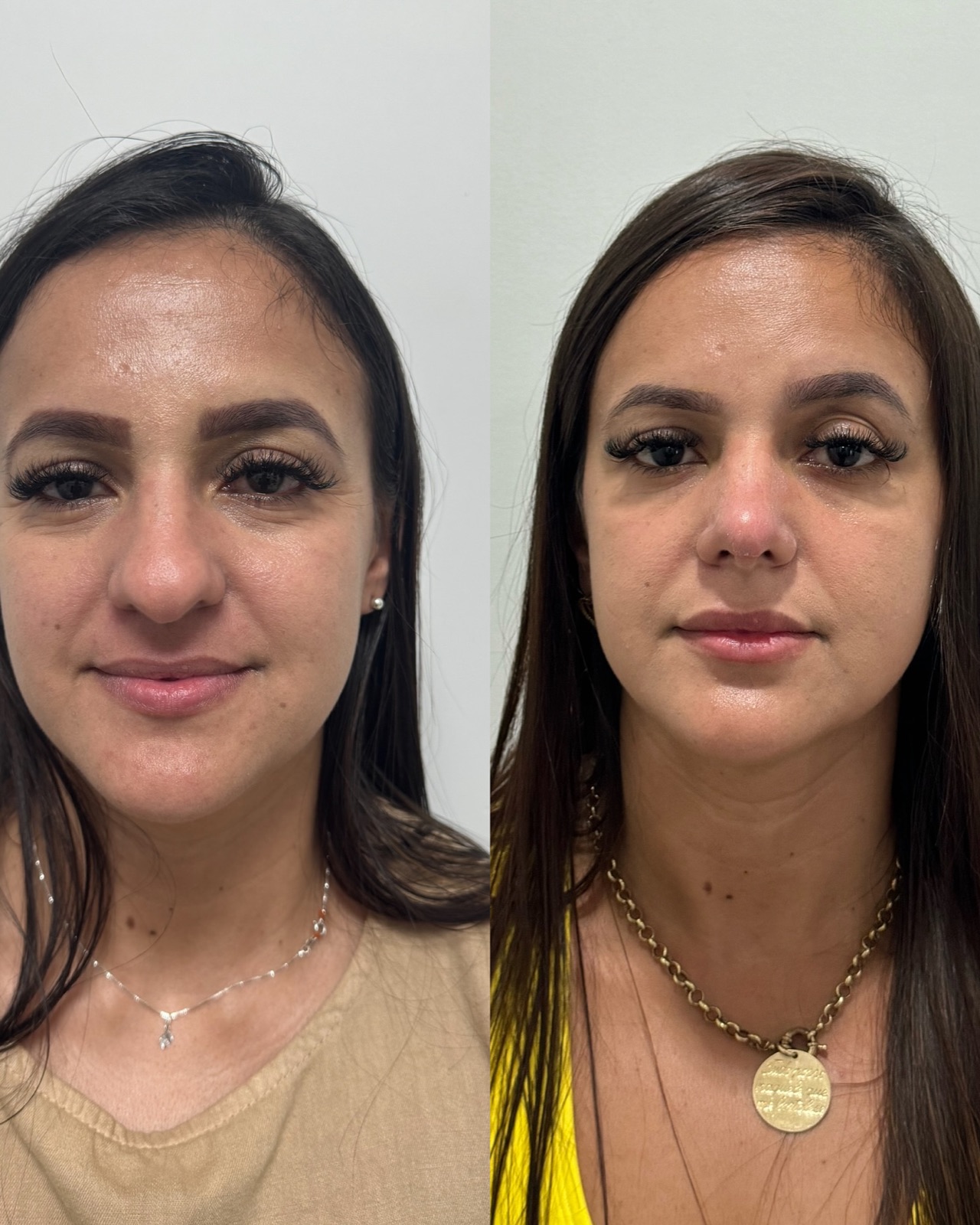 Resultado real de paciente Prime HOF — antes e depois