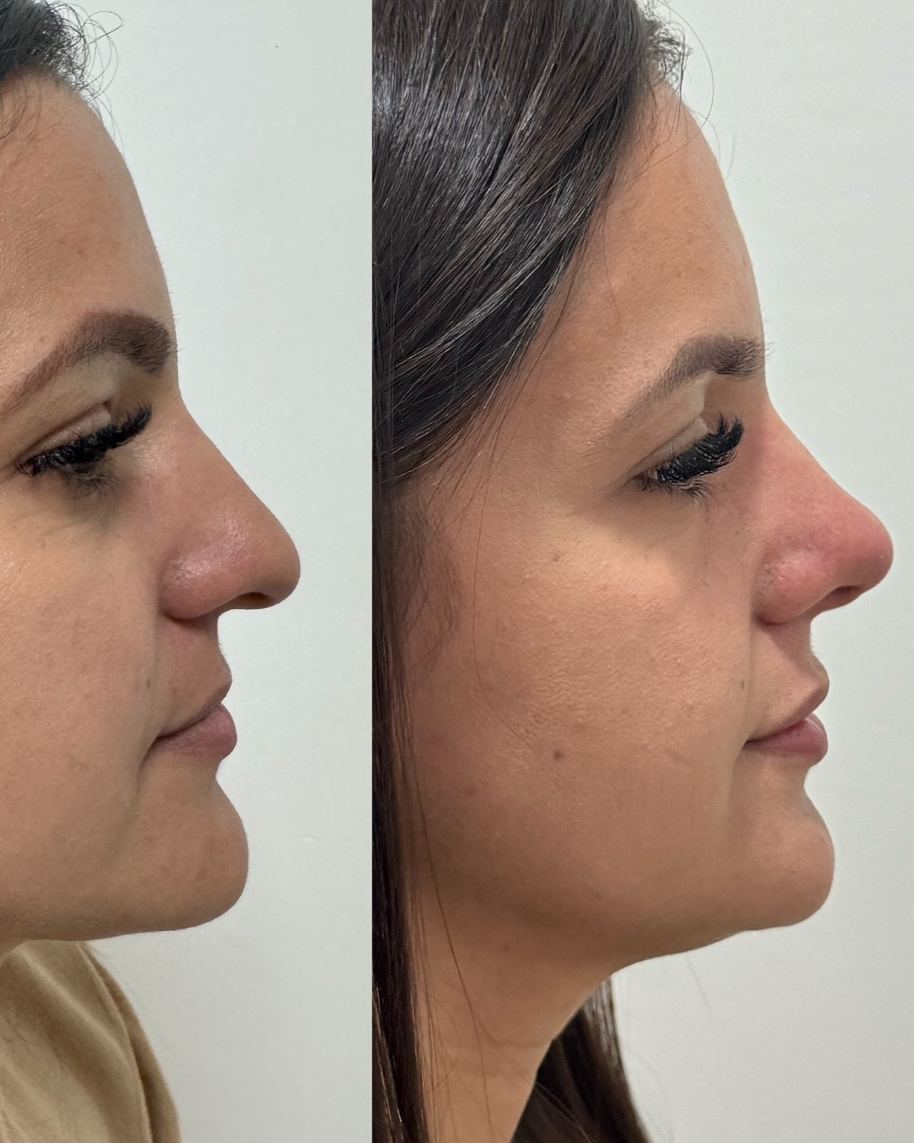 Resultado real de paciente Prime HOF — antes e depois