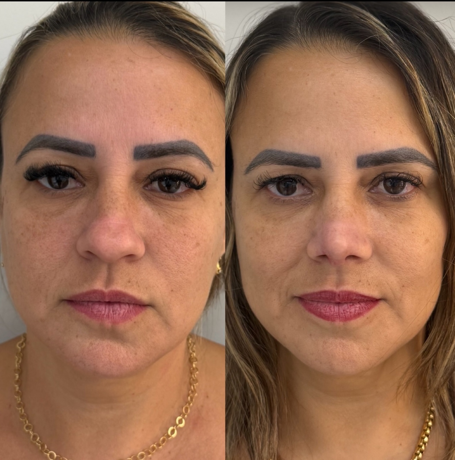 Resultado real de paciente Prime HOF — antes e depois