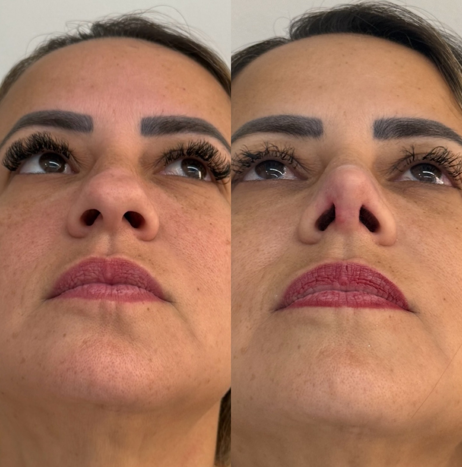 Resultado real de paciente Prime HOF — antes e depois