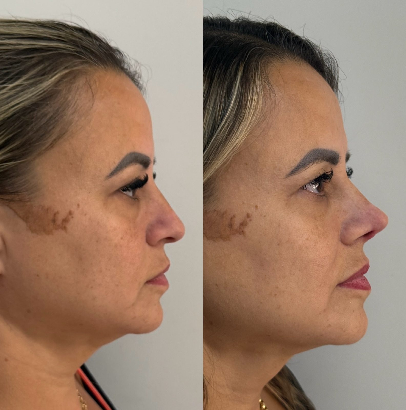 Resultado real de paciente Prime HOF — antes e depois