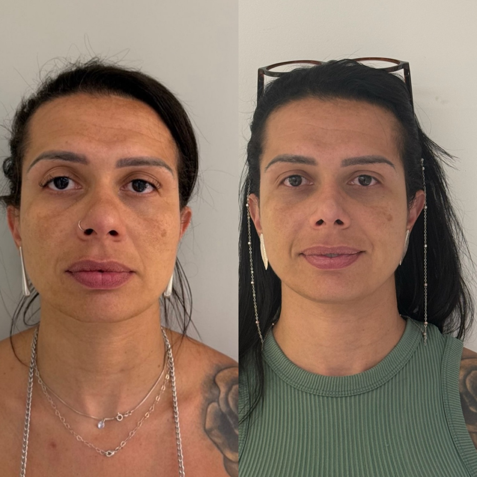 Resultado real de paciente Prime HOF — antes e depois