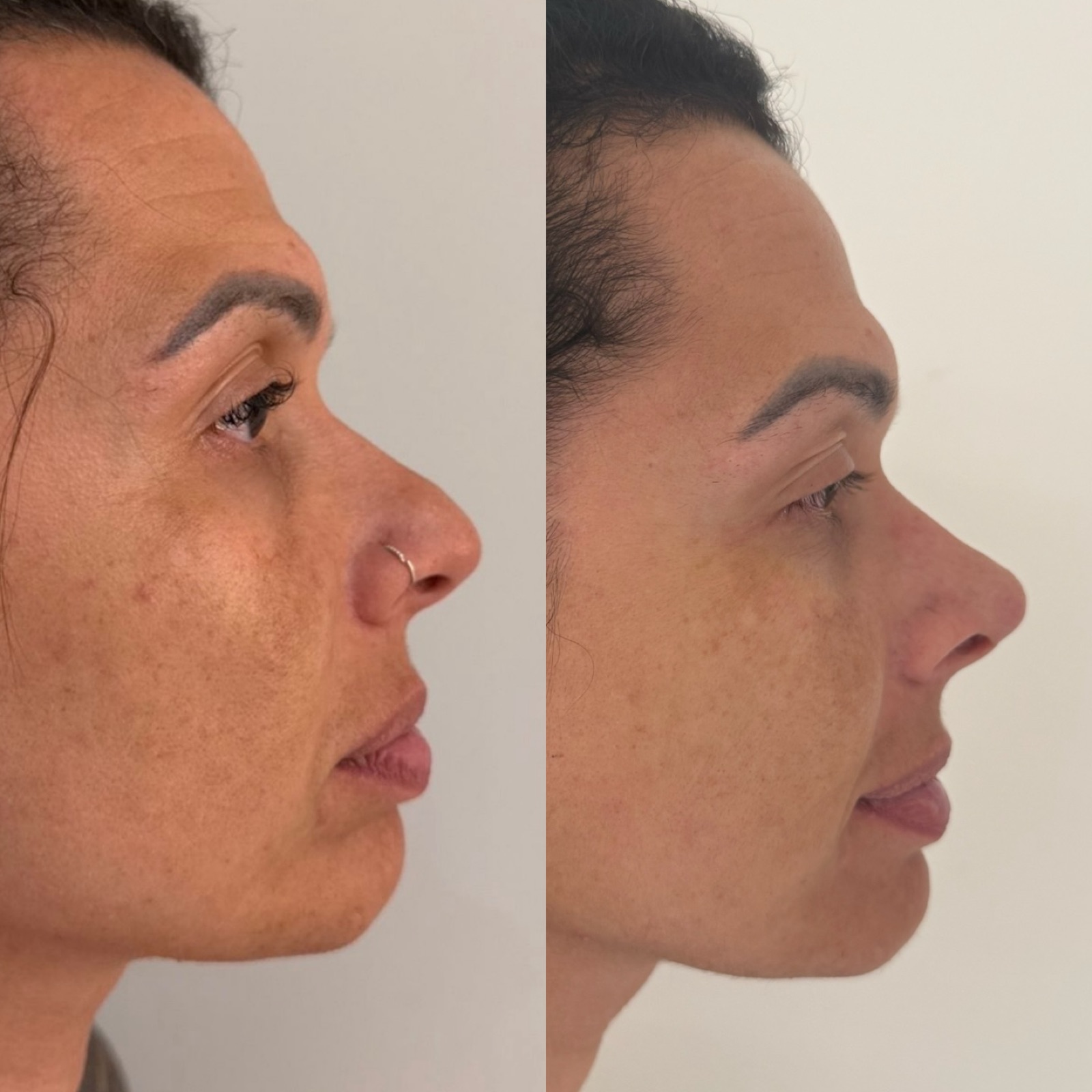 Resultado real de paciente Prime HOF — antes e depois