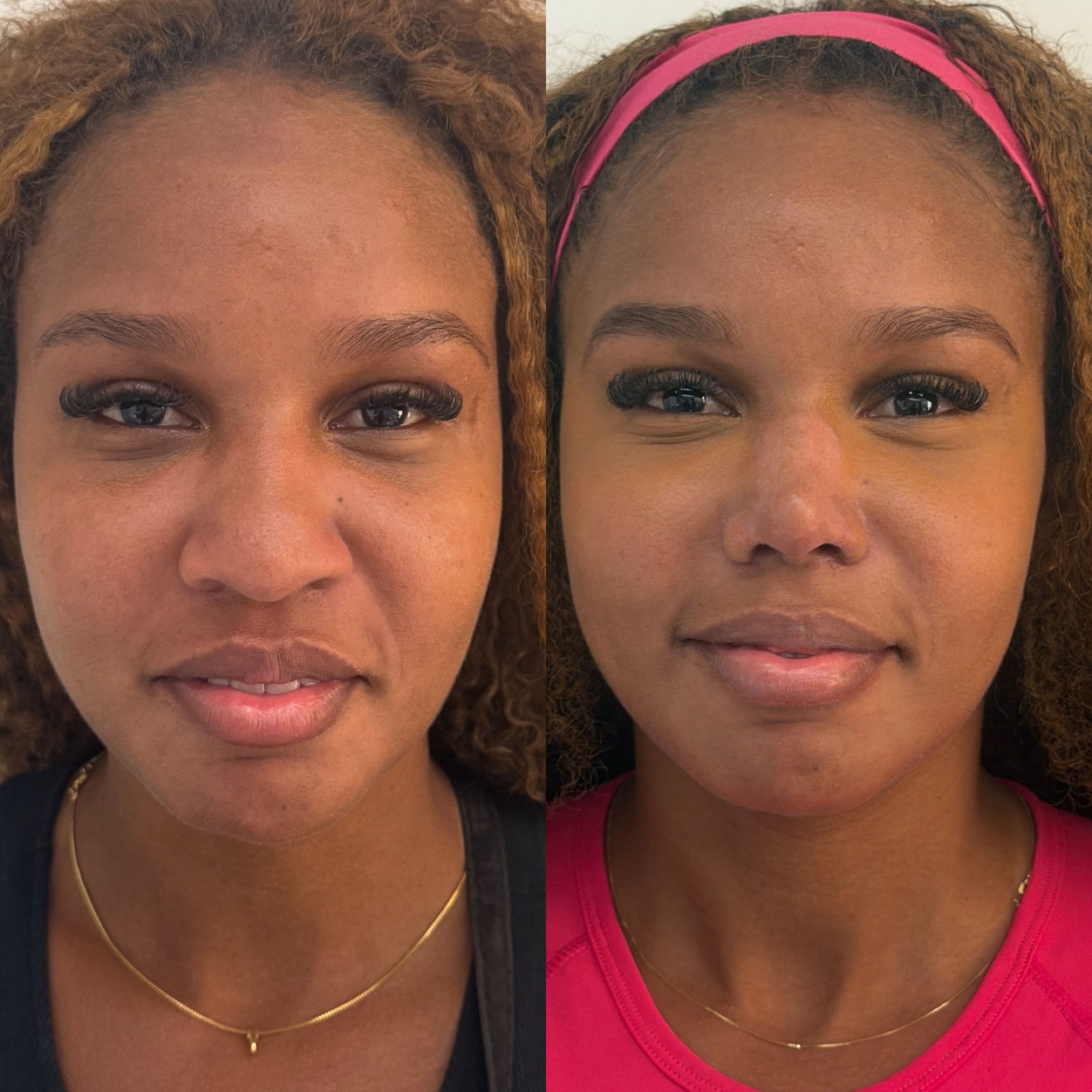 Resultado real de paciente Prime HOF — antes e depois